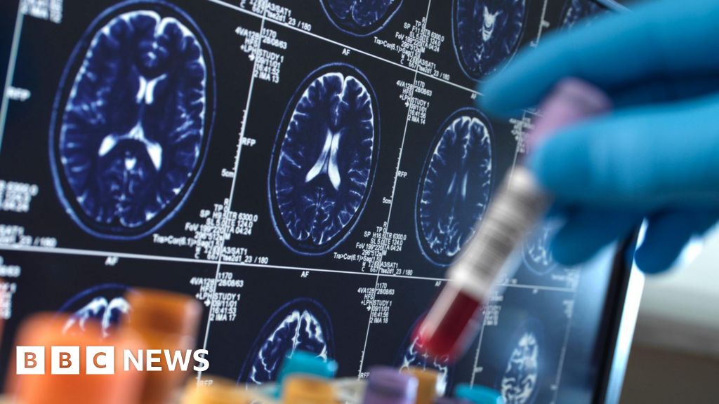 médicaments - Les médicaments contre Alzheimer qui ralentissent la maladie ne seront pas disponibles sur le NHS