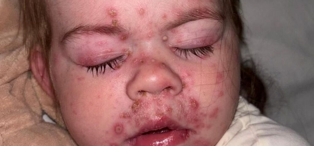 vaccin - Enfants bénéficient du vaccin contre la varicelle via le NHS