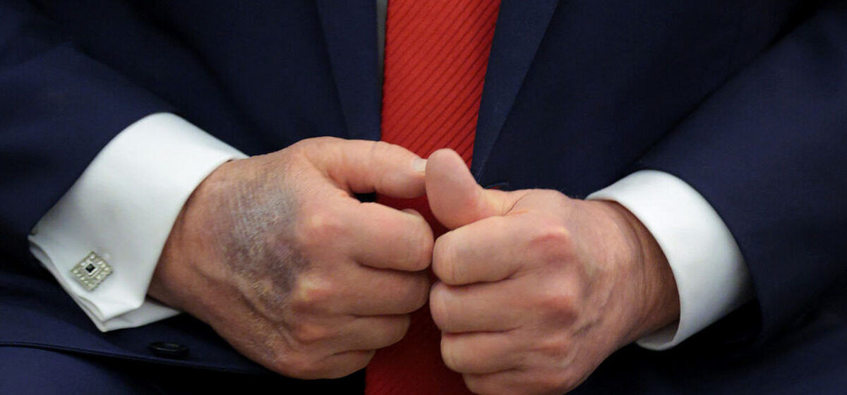 aspirine - Donald Trump explique ses hématomes par la dose d'aspirine qu'il prend et dément s'être endormi.