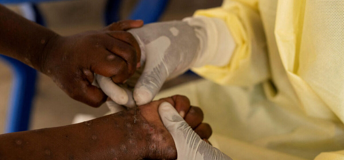 Mpox - « Le Nombre De Cas Suspects A Diminué De 40 % : Le Mpox N’est Plus Considéré Comme Une Urgence De Santé Publique En Afrique »