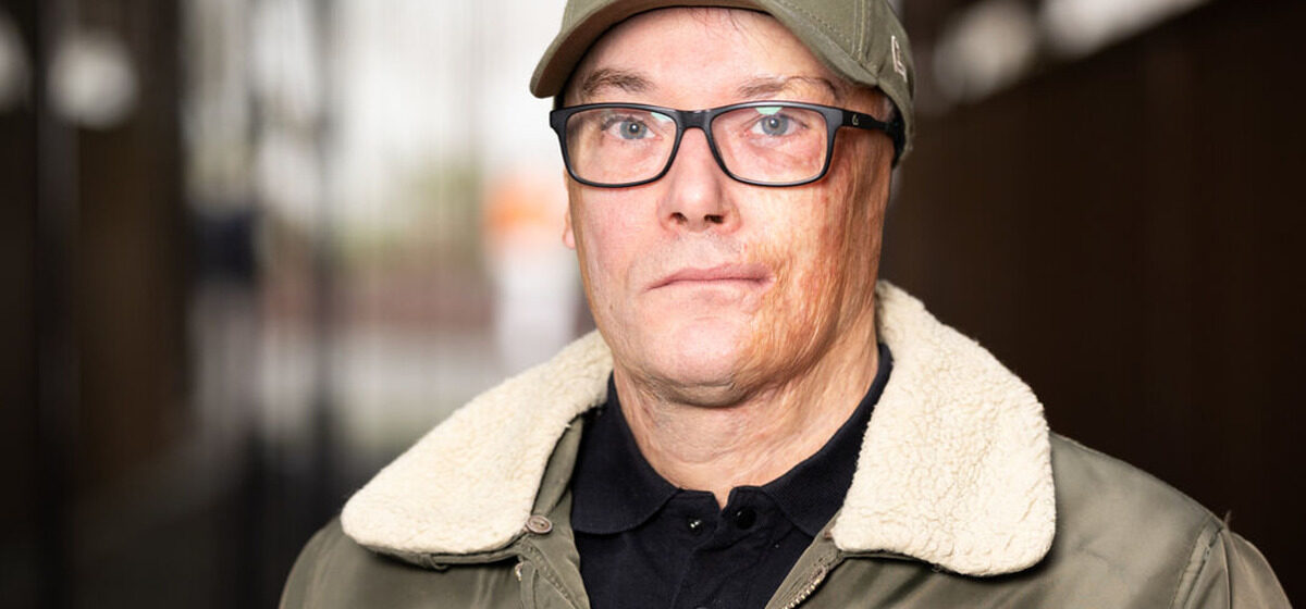 Oreille - « Pépé, Elle Est Où Ton Oreille ? » : Guillaume, Gravement Brûlé Après Avoir « Fait Le Con » Sur Un RER à 16 Ans